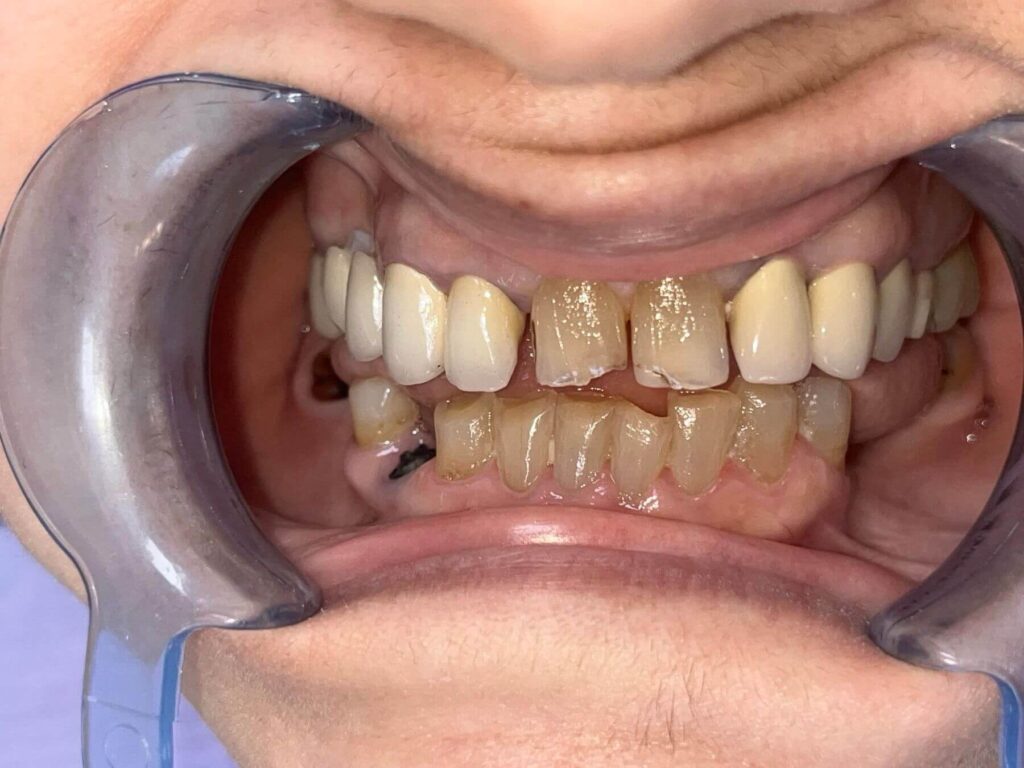 Pre ugradnje kompozitnih faseta