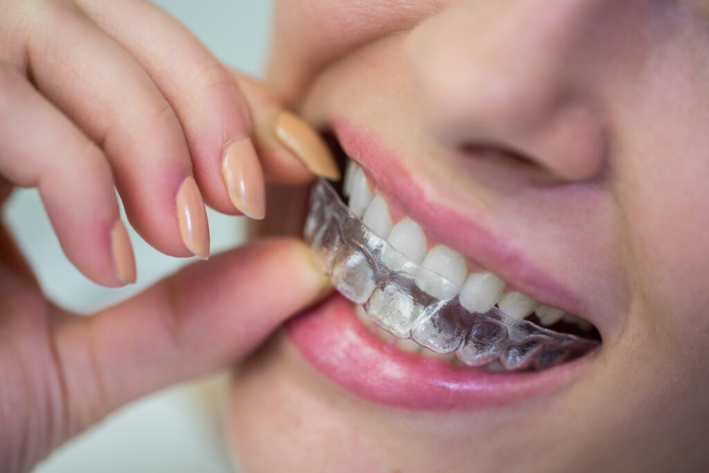 Close up of woman wearing orthodontic silicone invisible braces