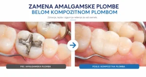 Zamena plombe blog