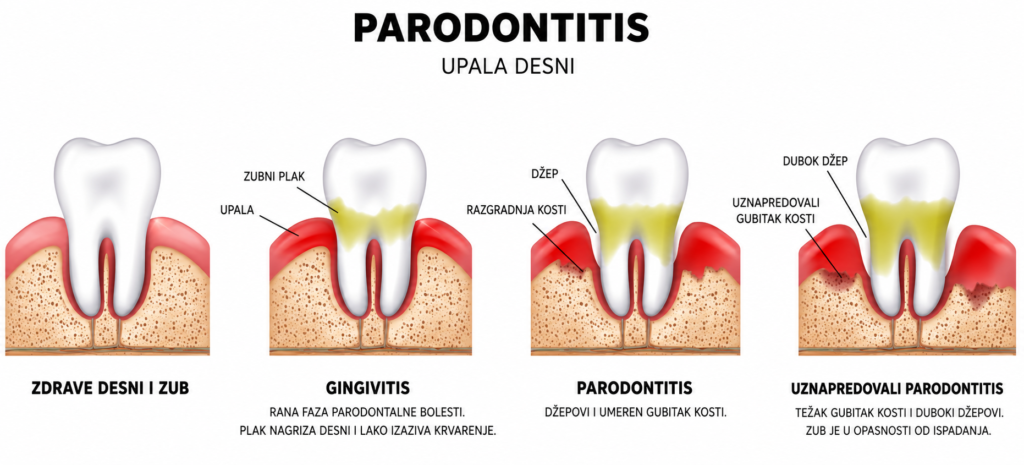 Parodontitis